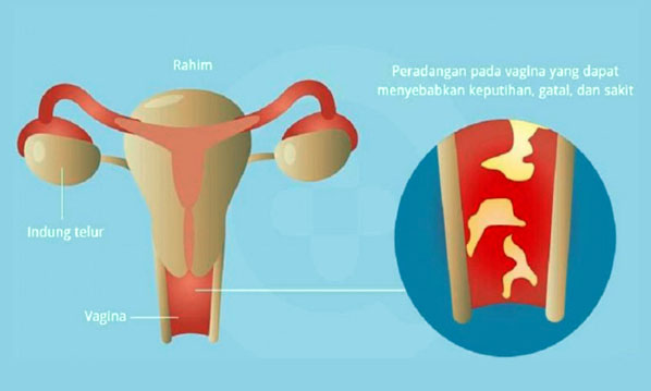 Mudah Didapat! Ini 5 Bahan Alami yang Mampu Menghilangkan Rasa Gatal pada Miss V