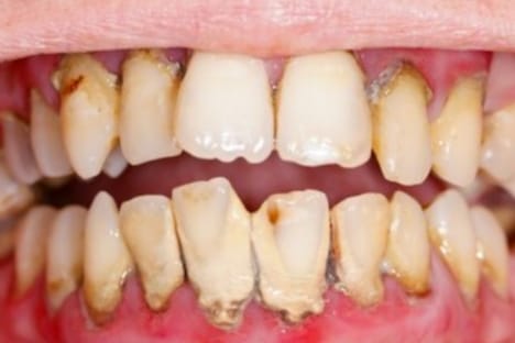 Anda Bermasalah dengan Karang Gigi yang Membandel? Gunakan Bahan Alami Ini Dijamin Gigi Jadi Putih Kembali