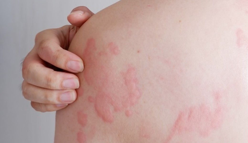 Yuk Simak! Begini Cara Mencegah Biduran Atau Kaligata