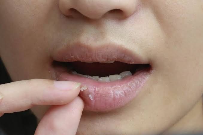 4 Penyebab Bibir Kering dan Pecah-pecah serta Cara Mengatasinya dengan Bahan Alami 