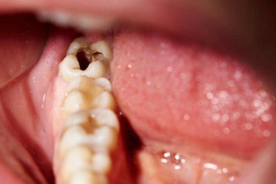 Cara Mengobati Gigi Bengkak atau Berlobang, Apa Sajakah Itu? Yuk Lihat Selengkapnya Disini