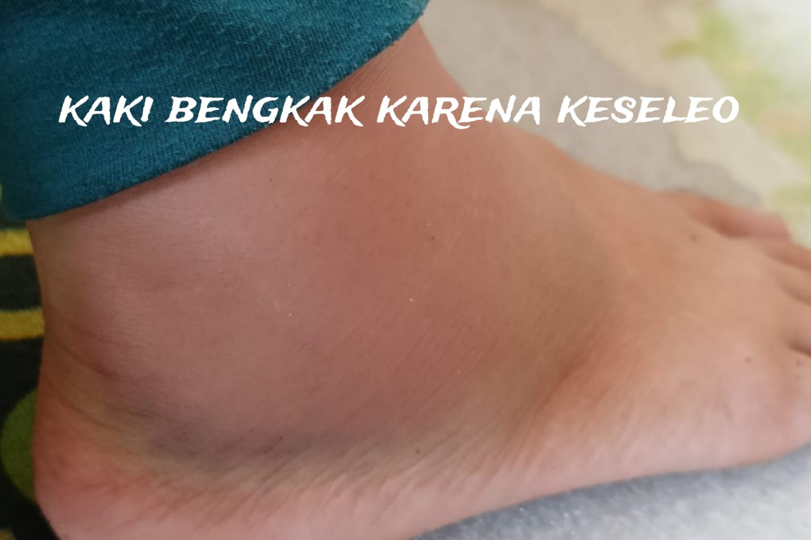 Kaki Keseleo? Begini 6 Tips Mengobatinya dengan Mudah, Dapat Meringankan Rasa Nyeri