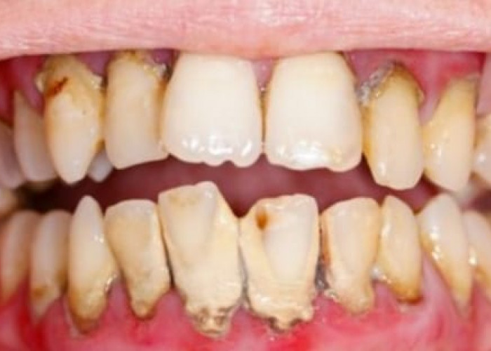 Anda Bermasalah dengan Karang Gigi yang Membandel? Gunakan Bahan Alami Ini Dijamin Gigi Jadi Putih Kembali