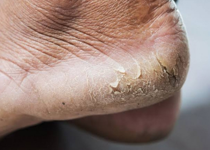 Kamu Mengalami Kaki Pecah-pecah? Ini 7 Cara Mengatasinya