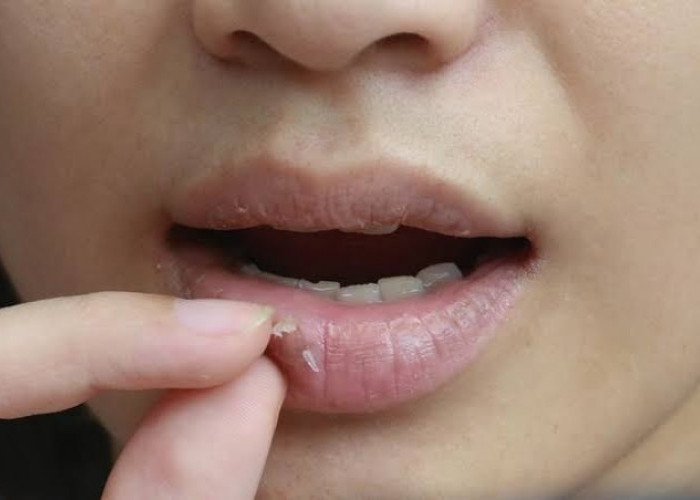 4 Penyebab Bibir Kering dan Pecah-pecah serta Cara Mengatasinya dengan Bahan Alami 