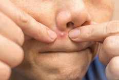 Ini Dia 5 Cara Menghilangkan Jerawat Batu yang Membandel, Yuk Lihat di Sini