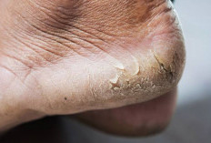Kamu Mengalami Kaki Pecah-pecah? Ini 7 Cara Mengatasinya
