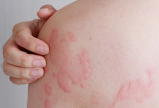 Yuk Simak! Begini Cara Mencegah Biduran Atau Kaligata